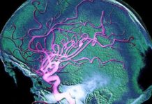 Le sel, accélérateur d’Alzheimer cerveau Alzheimer