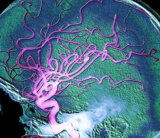 Le sel, accélérateur d’Alzheimer cerveau Alzheimer
