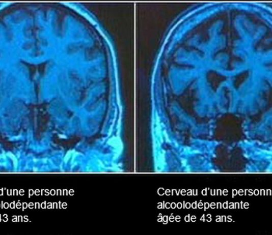 alcool alzheimer