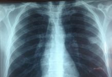 Les microplastiques atteignent les poumons microplastiques