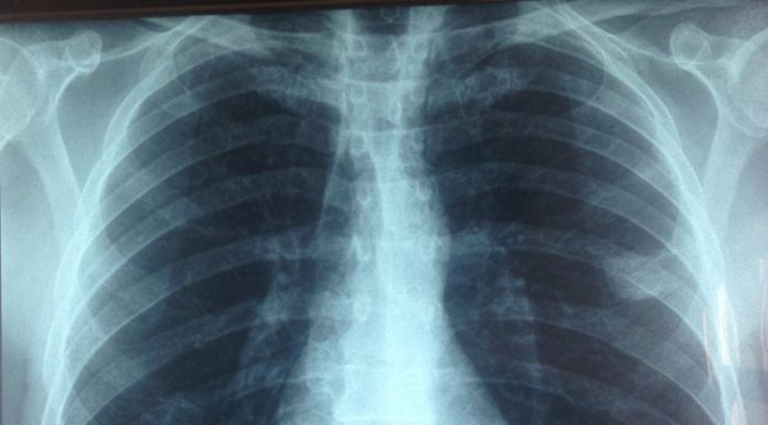 Les microplastiques atteignent les poumons microplastiques