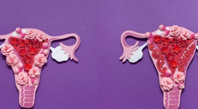 Atténuer l’endométriose endometriose