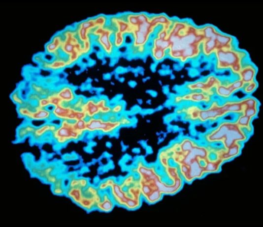 sucre cerveau