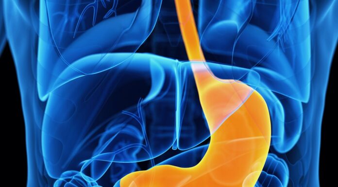 reflux gastro-oesophagien