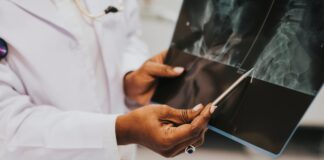 Cadmium et ostéoporose, un nouvel aspect du scandale sanitaire osteoporose